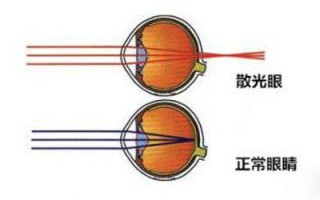 散光度数小了会怎么样，散光度数小了会怎么样吗